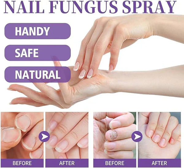 Nail Fungus Spray - Fast-Acting Antifungal Treatment for Healthy Nails & Skin Relief